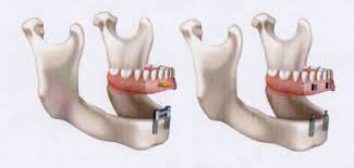 Tandtechniek in Doetinchem, Implantoloog nabij Zevenaar, immediaatprothese regio Bronckhorst